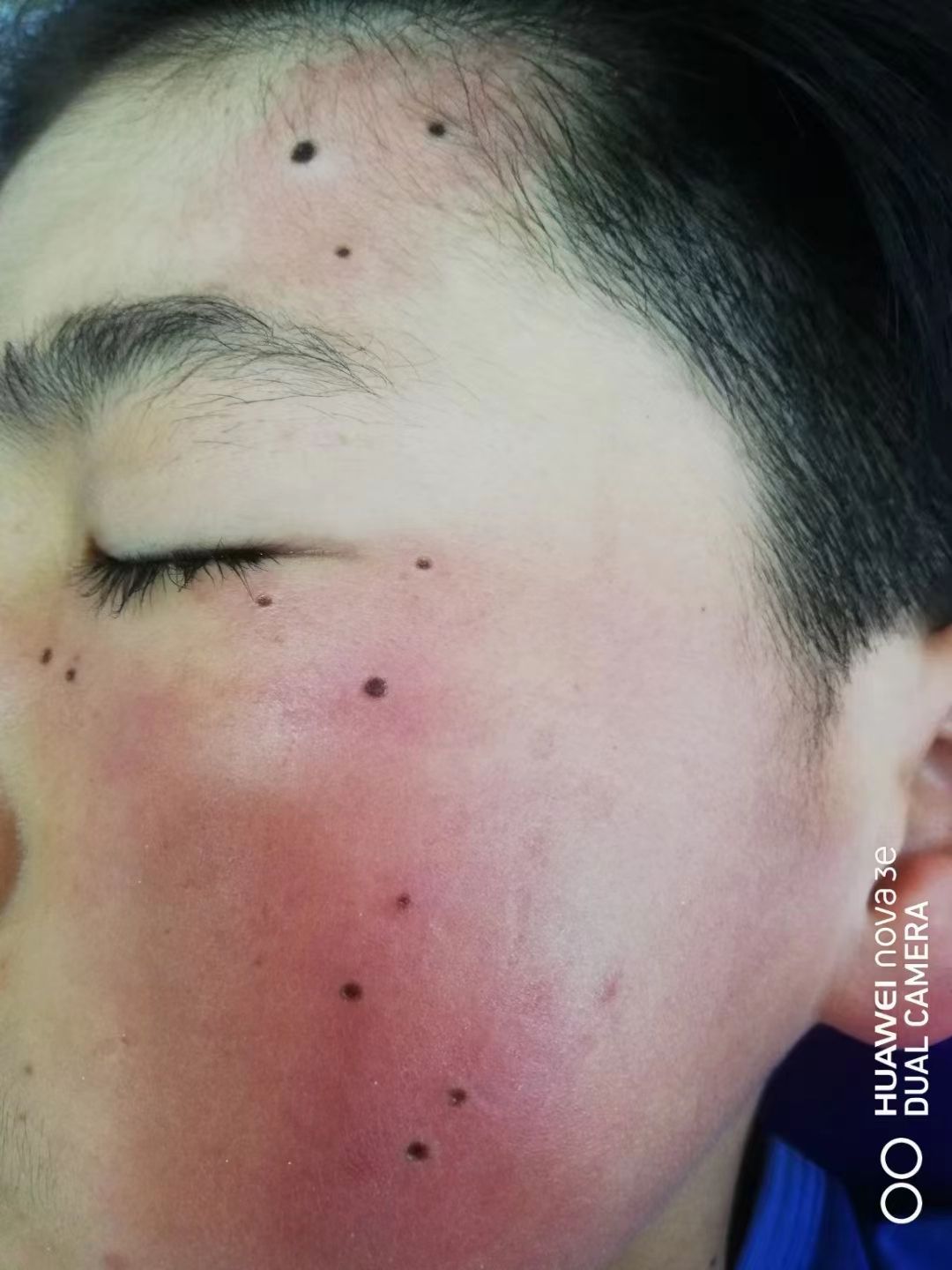 优尚美专业祛斑点痣